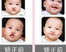 吃兔肉真的會(huì)長(zhǎng)兔唇？為什么會(huì)長(zhǎng)兔唇？